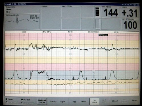 Monitor yang merekam kontraksi rahim